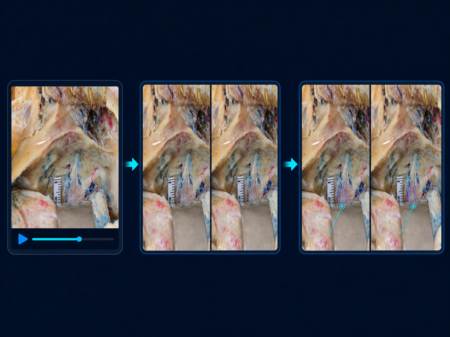 A three-step medical media workflow showing source video, stereoscopic conversion, and depth-aware annotations.